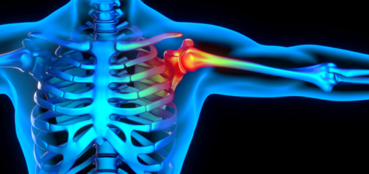 Shoulder Replacement: Causes, Treatment, Cost, and Recovery