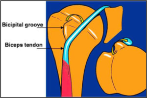 Biceps Tendon Subluxation