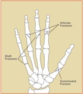 Hand Fractures