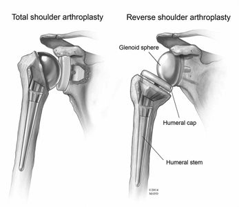 Anatomical Total Shoulder Replacement