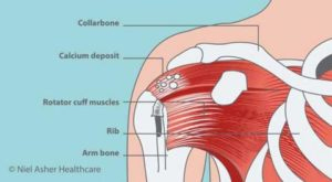 Calcific Tendinitis