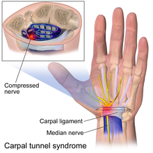 Carpal Tunnel Syndorme