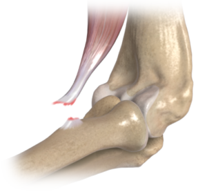 Distal Biceps Rupture