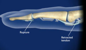 Flexor Tendon Injuries