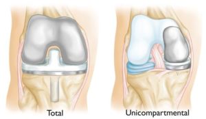 Knee Replacement