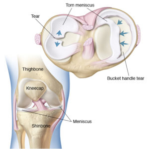 Meniscus Tear