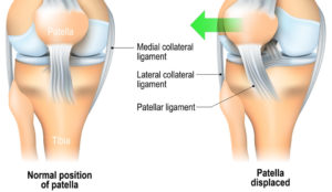 Patellar Dislocation