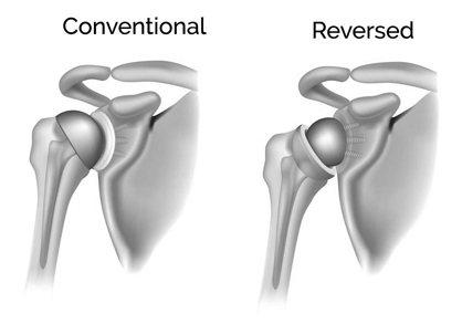 Reverse Total Shoulder Replacement