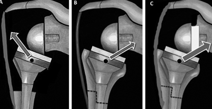 Revision Total Shoulder Replacement Surgery