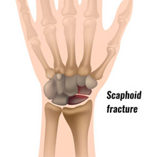 Scaphoid Fracture