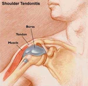 Shoulder Impingement