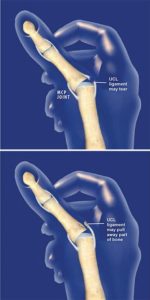 Thumb UCL Rupture