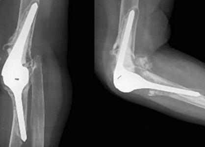 Total Elbow Replacement