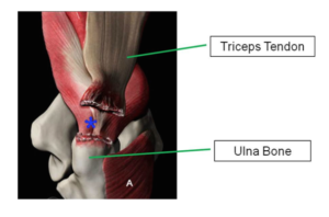 Triceps Tendon Rupture