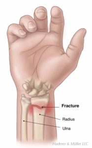 Wrist Fracture